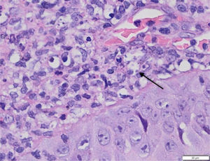 Anatomopathological examination of a plantar ulcer showing dermal infiltrate and amastigotes of L. braziliensis inside macrophages (arrow). (Hematoxylin & eosin, ×100).