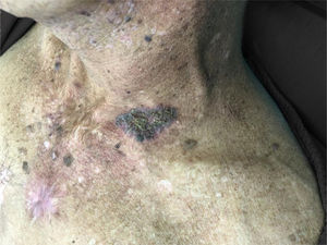 Desquamative plaque on the anterosuperior thorax.