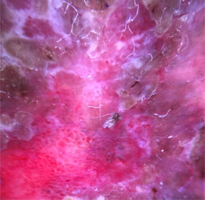 Dermoscopy after removal of crusts, displaying glomerular vessels.