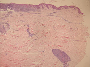 In the papillary dermis, intense inflammatory infiltrate with a predominance of lymphocytes is shown, without compromising the epidermis. In the deep reticular dermis, medium-caliber vessels surrounded by mononuclear infiltrates are shown (Hematoxylin & eosin, ×40).