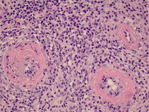 The detail shows three vessels with wall involvement by the inflammatory infiltrate, with a predominance of lymphocytes and an amorphous eosinophilic substance in the lumen, suggestive of fibrin (Hematoxylin & eosin, ×400).