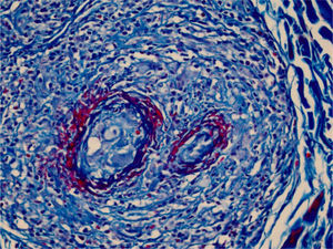 The use of Masson’s trichrome staining shows that the destruction of the vascular wall and muscle layer was intense, since no smooth muscle fiber stained in red is observed, and the amorphous material in the lumen is stained red, characterizing the aspect of “fibrin ring” (Masson’s trichrome, ×400).