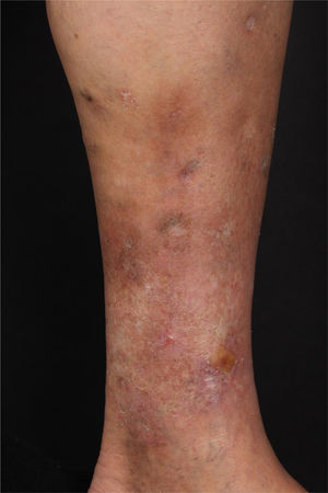 Good clinical response after increasing the azathioprine dose to 250 mg.