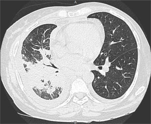 Paracoccidioidomycosis and liver transplantation: CT scan showing peribronchial and perivascular parenchymal consolidations.