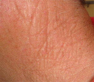 Clinical aspect on the left cervical region.