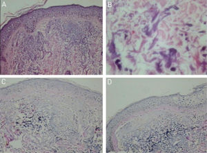 Optical microscopy: (A) basophilic alterations in the superficial dermis (Hematoxylin & eosin ×150). (B) Detail of basophilic alterations with irregular and fragmented material (Hematoxylin & eosin, ×400). (C and D) Reduced elastic fibers in the basophilic areas (Verhoeff, ×150).