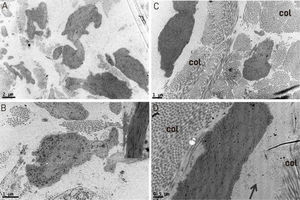 Transmission electron microscopy: (A) fragmented and irregular elastic fibers (×18,000). (B) detail of an irregular elastic fiber with modification in the distribution of dark spots inside it, inset showing normal fiber for comparison (×20,000). (C) normal collagen fibers (col) (×12,000). (D) Detail of an altered elastic fiber with an irregular interior, deposition of amorphous material (arrow) and normal collagen (col) in cross-sectional and longitudinal sections, with normal periodicity in the lower right quadrant (×25,000).