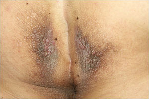 Confluent brown papules and plaques on the perianal area.