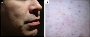 (A) Skin-colored papule on the right cheek. (B) Polarized dermoscopic image showing non-characteristic features.