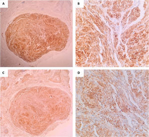 (A and B) Positive immunohistochemistry exam for S100. (C and D) Positive immunohistochemistry exam for GFAP.
