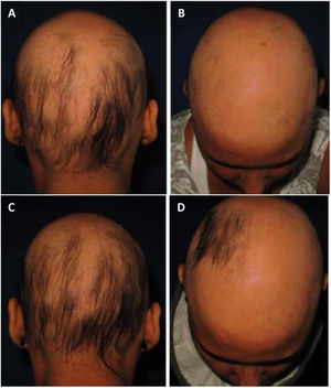(A and B) DPCP – initial appointment; (C and D) DPCP – 17 applications. The patient was treated with 17 applications of DPCP and presented hair regrowth. (A and B) Initial assessment; (C and D) after 17 applications of DPCP.