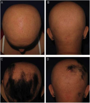 Anthralin: (A and B) Initial pictures; (C and D) after 24 weeks of treatment. Patient was treated with Anthralin for 24 weeks. (A and B) Initial assessment; (C and D) after 24 weeks of treatment.