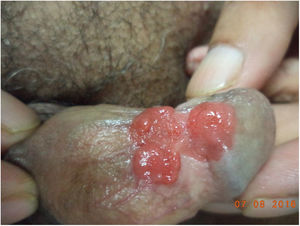 Right axilla presenting discrete and grouped skin-colored, shiny, firm, monomorphic round, and dome-topped papules of 1-to 3-mm.