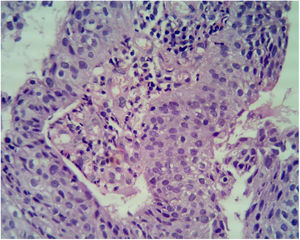 Beefy red asymptomatic penile lesion: unusual presentation of squamous cell carcinoma. Atypical cells with nuclear overcrowding, loss of polarity, lack of surface maturation, high N:C ratio, hyperchromatic nuclei, and multiple mitotic figures. Focal clear cell change is noted at the junction of atypical epithelium and normal epithelium (Hematoxylin & eosin, ×40).
