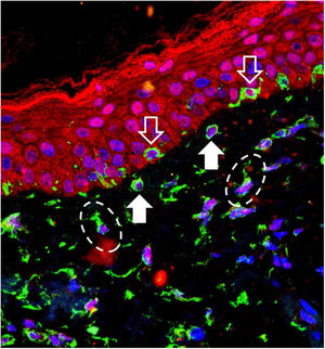 Overlapping image of triple-labeling immunofluorescence on skin with melasma. Labeling in green (vimentin), red (Opsin-3), blue (cell nuclei). White outline arrow: melanocytes in the basal layer. Full white arrow: pendulous melanocytes. Dashed ellipses: upper dermis fibroblasts.