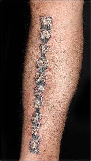 Clinical aspect after a few weeks: verrucous appearance of the regions tattooed with red pigment.