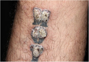 Closer view of the verrucous lesions - note that areas tattooed in black are spared.