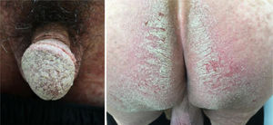 Erythematous plaques covered with thick white scales on the glans and gluteal region.