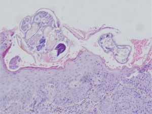 Skin biopsy from glans showed hyperkeratosis, acanthosis of stratum malpighii. Stratum corneum revealed multiple subcorneal burrows containing Sarcoptes scabiei larvae and eggs. Dermis had inflammatory cell infiltration rich in eosinophils and lymphocytes (Hematoxylin & eosin stain, original magnification, ×20).