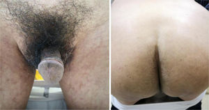 At the fourth week’s follow-up, the skin lesions almost disappeared.