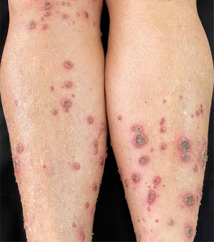 Multiple erythematous papules and crater-like ulcerations on lower limbs with associated xerosis.