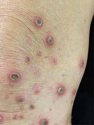 Crater-like ulcerations with a central keratotic plug.