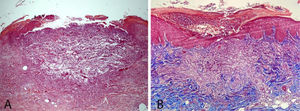 (A), Histopathological exam showing a cup-shaped lesion containing keratin, cellular debris, neutrophils and collagen and elastic fibers (Hematoxylin & eosin, ×50). (B), Presence of intraepidermal collagen fibers perpendicular to the skin surface. (Masson’s trichome, ×40).