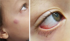 Clinical presentation of patient 1: granular erythematous lesion on the right lower tarsal conjunctiva and submandibular lymphadenopathy (Parinaud