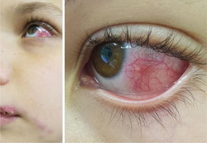 Patient 2 showing the lymphocutaneous form caused by the cat scratch on the upper lip and ocular involvement caused by sneezing of the sick cat.