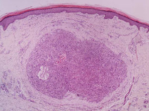 Dermal leiomyosarcoma – low power field. Nodular lesion located in the dermis, non-encapsulated, and without connection with the adjacent epidermis (Hemathoxylin & eosin, ×40).
