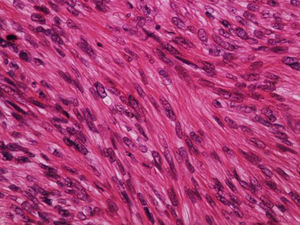 Dermal leiomyosarcoma – high power field. The cells are spindle-shaped, with elongated nuclei and blunt ends, inconspicuous nucleolus, and fibrillary eosinophilic cytoplasm (Hemathoxylin & eosin, ×400).