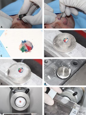 Surgical Technique. (A), Clinically evident tumor is removed (debulking) by saucerization. (B), First stage margins are removed at a 45-degree angle. (C), Surgical specimen flattened (lateral margins are on the same plane as the deep margin) and colored with different dyes for orientation. (D), Surgical specimen frozen on a metal plate. (E–F) A specific gel called Optimum Cutting Temperature (OCT) is added to the metal plate to create the tissue block. (G), Tissue block ready for sectionning. (H), The tissue block is sectioned on a microtome and several sections are placed on the histologic slides. Slides are then stained and coverslipped (not shown in the figure) before microscopic examination.
