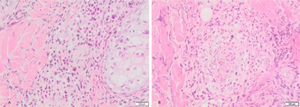 (A), Atypical perivascular and perianexial lymphoid infiltrates. (B), Angiocentricity.