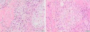 (A), Atypical perivascular and perianexial lymphoid infiltrates. (B), Angiocentricity.