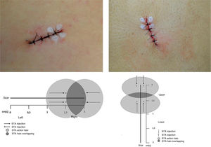 Marking of BTA stitches with a schematic representation of the proposed methodology.