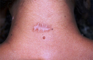 Final aspect with smaller width and less raised scar tissue on the side treated with BTA at the end of the follow-up.