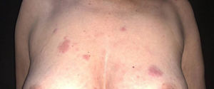 Cutaneous mantle-cell lymphoma. Infiltrated purplish erythematous papules and plaques, located on the upper thorax.