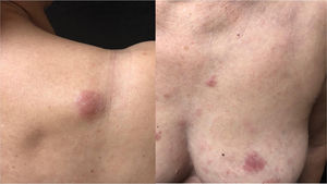 Infiltrated plaque in the scapular region and infiltrated papules and plaque on the breast and sternal regions.