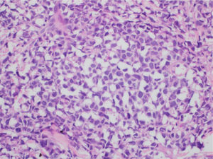 Detail of the neoplastic infiltration with an accumulation of blastoid cells, with large, irregular nuclei and scarce cytoplasm. (Hematoxylin & eosin, ×200).