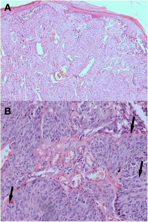 Histopathological image of the melanoma. Caption: Nodular melanoma, epithelioid type, Clark 3, Breslow 2.39-mm. (A), Hematoxylin & eosin ×40, (B), Hematoxylin & eosin ×100. The arrows indicate the pathological mitoses in the tumor.