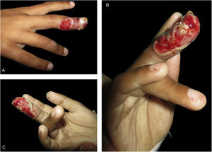 (A-B-C) Extensive ulceration with the border outlined by a whitish epidermal flap on the third right finger, with periungual involvement. On the fourth right finger an umbilicated vesicle can be observed.