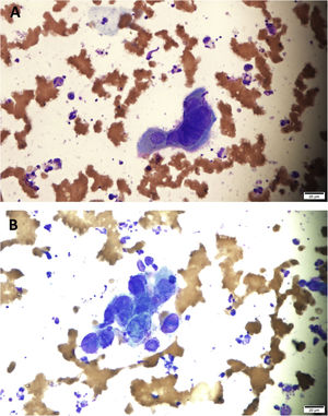 (A–B) multinucleated squamous cells with nuclear molding and ground-glass appearance compatible with HSV viral infection (Giemsa, ×400).