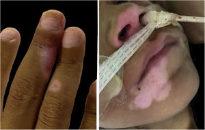 Residual hypochromic lesions after acyclovir therapy.