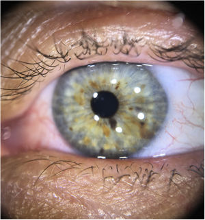 Dermoscopy with polarized light: Lisch nodules on the iris (brownish-yellow lesions of varying hues, with wide distribution).