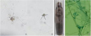 Mycological examination of a chromoblastomycosis case. (A and B), direct mycological examination (KOH 20%, ×200) showing the “Borelli spiders” in two different fields. (C and D), Fungal culture with macro-microscopic morphology compatible with Fonsecaea pedrosoi.