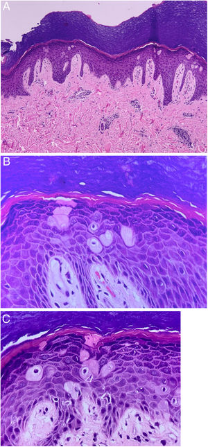 Pagetoid dyskeratosis. (A) Hyperkeratosis, hypergranulosis and mild acanthosis. Bulky cells with large eosinophilic cytoplasm, pyknotic nucleus, and clear perinuclear halo amid keratinocytes. Congested superficial and deep dermis and discrete perivascular lymphohistiocytic infiltrate (Hematoxylin & eosin, ×100). (B) and (C) Dyskeratotic cells are well seen (Hematoxylin & eosin, ×400).