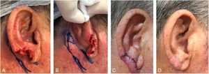Retroauricular interpolation flap for the lobule. (A), Full-thickness surgical defect. (B), Flap design. (C), One week after the first stage. Note the pedicle at the bottom part of the figure. (D), Three months of postoperative period. Note the adequate repair of the lobule contour and maintenance of the ear size.