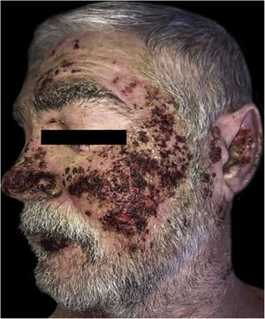 Pemphigus vulgaris and obsessive-compulsive behavior. The multiple lesions are covered by hemato-meliceric crusts on the face.