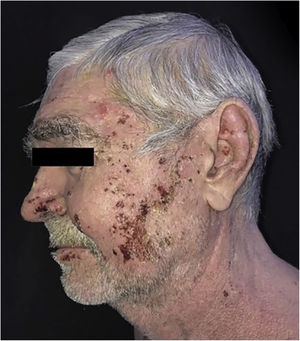 Pemphigus vulgaris and obsessive-compulsive behavior. Evolution after 40 days of the established therapy.