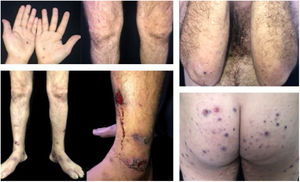 Purpuric lesions on the hands; papulopustular, purpuric, and ulceronecrotic lesions on the lower limbs, and ulceronecrotic lesions on the gluteal region and elbow.
